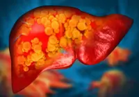 An Experimental Drug Developed at Michigan Medicine Reverses Severe Fatty Liver Disease in Animal Studies by Targeting the Gut